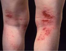 Eczema legs