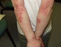 eczema